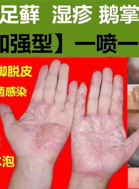 足癣药膏真菌感染