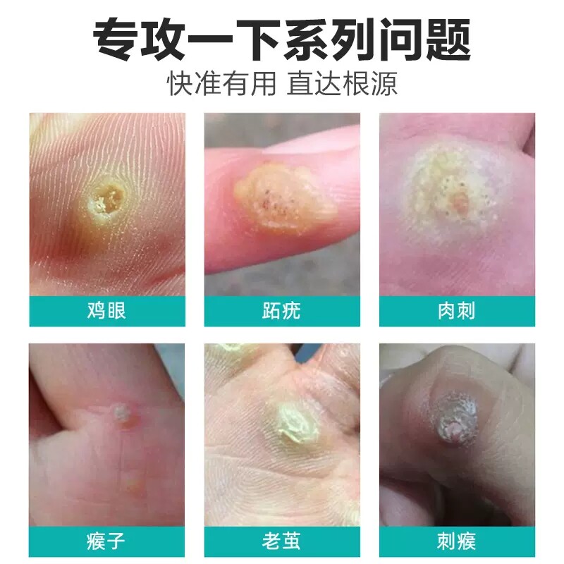 同仁堂鸡眼贴膏膏药鸡贴眼跖疣肉刺瘊子脚底疙瘩足部健康