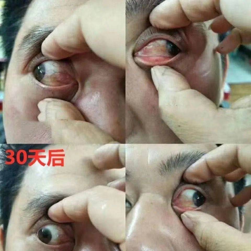 眼睛去除胬肉滴眼液翼状发红疙瘩发干异物感视力滴眼液护眼用品