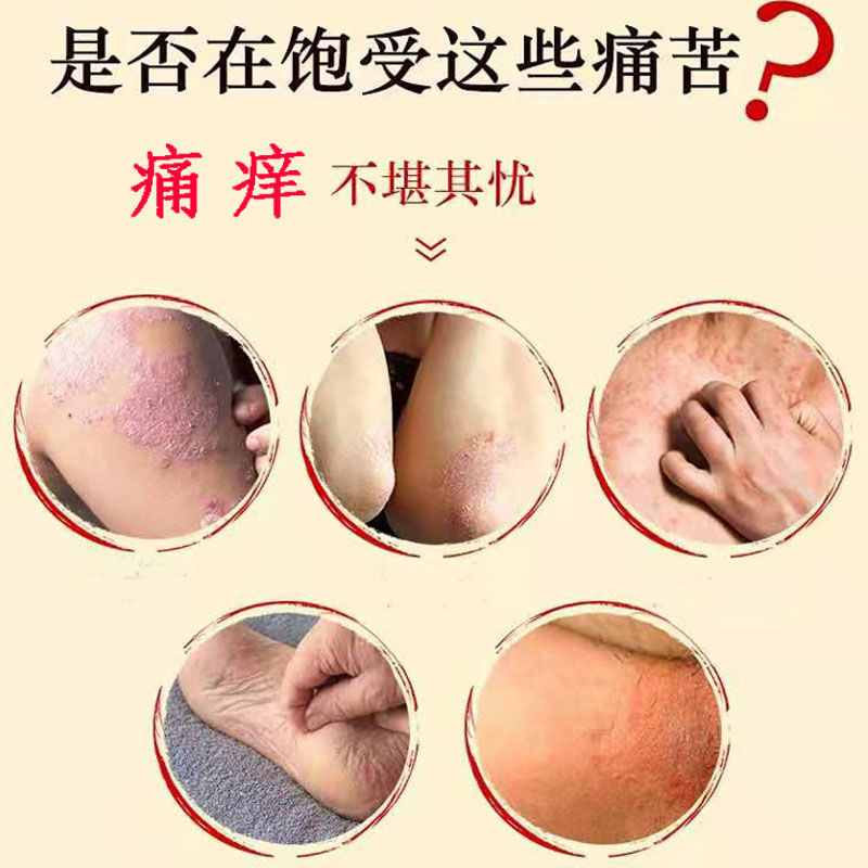 肛门瘙痒潮湿肛周脓肿屁眼男性皮肤阴囊屁股皮肤消毒护理(消)