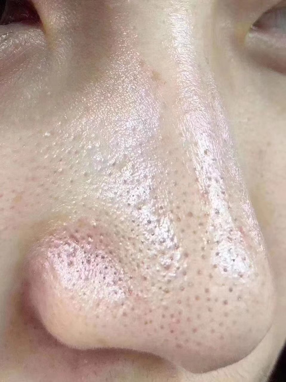 superextractor美国黑头导出皮肤管理美容院专用收缩黑头导出液