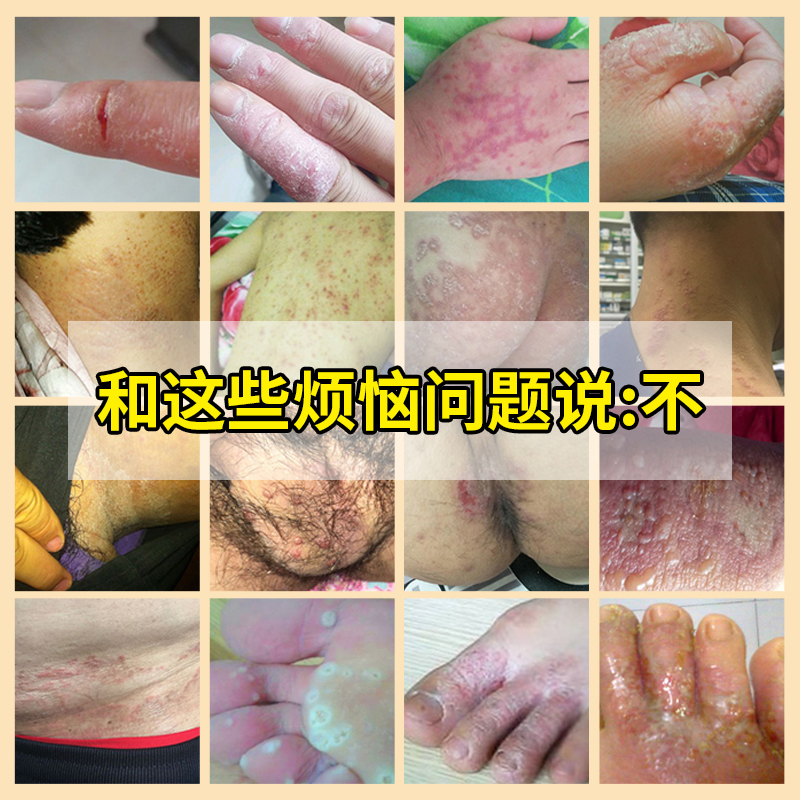 吴郎中肤康喷剂男女体藓干痒藓抑菌止痒防感染手足藓水泡喷剂