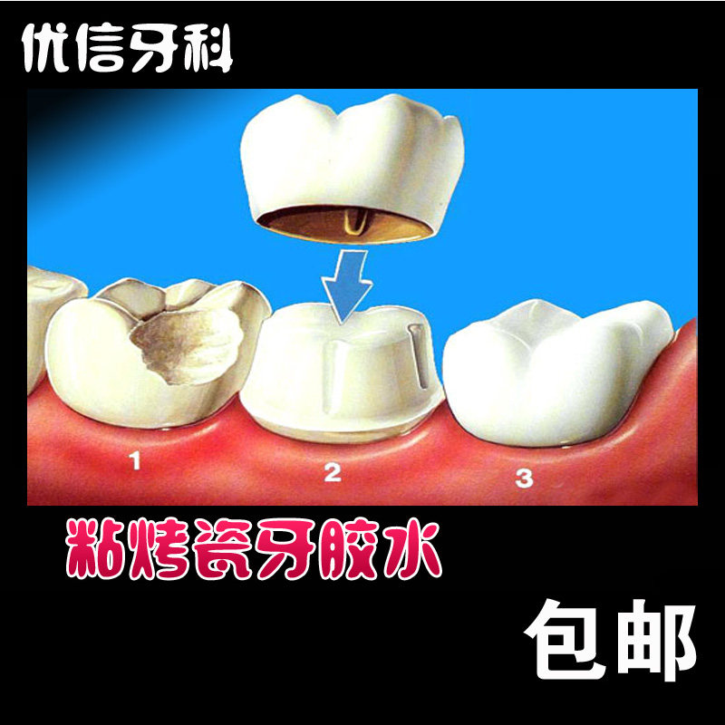 胶水自己动手粘牙牙齿假牙粘烤瓷牙专用材料胶水