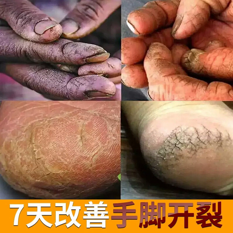 日本马油清足膏手脚裂膏防裂手脚开裂后跟脱皮皲裂膏裂口足裂干裂