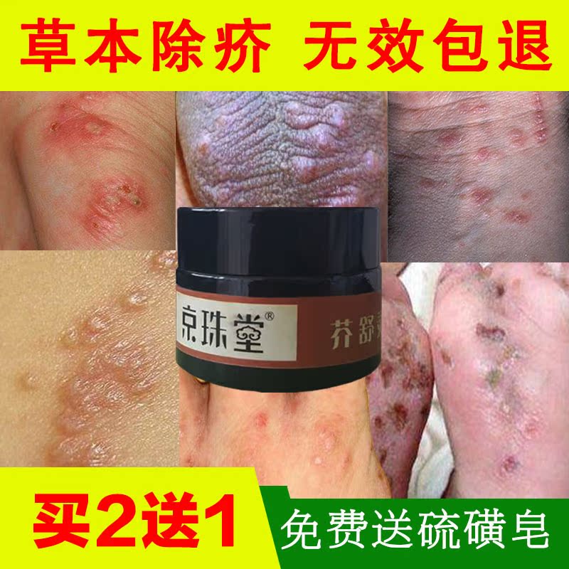 疥疮结节皮肤止痒特效硫磺软膏疥舒宁疥灵霜疥虱康宁螨虫外用药