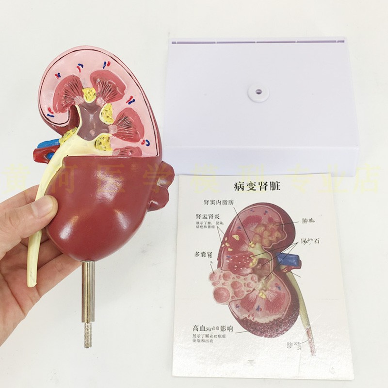 肾脏解剖模型人体病理病态泌尿医学病变其他模型玩具
