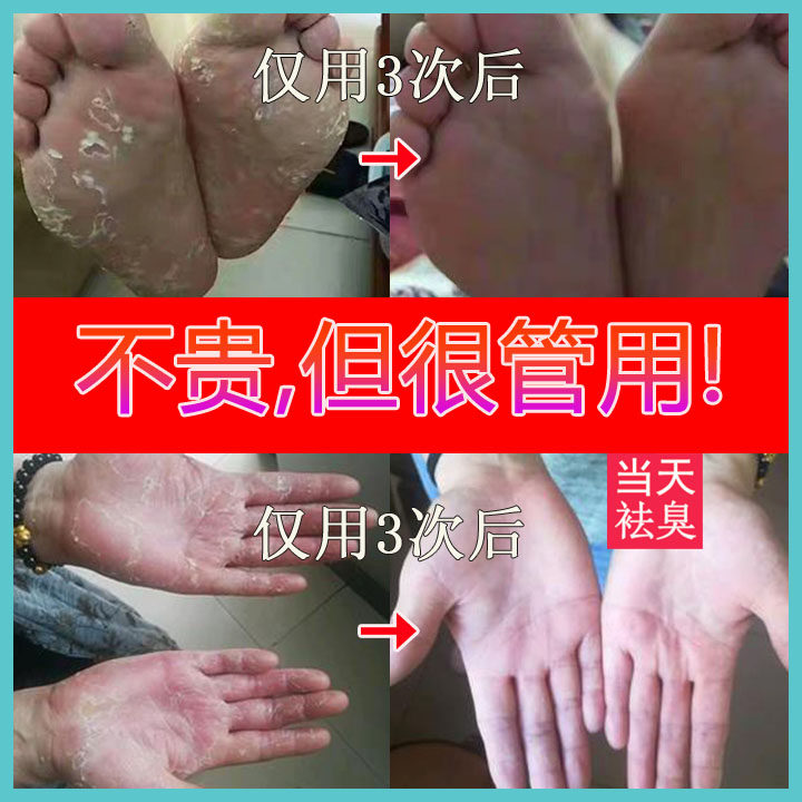 云南草本脚跟龟裂脚后跟干裂蜂蜡手足愈裂皲防裂冻裂疮膏手脚开裂