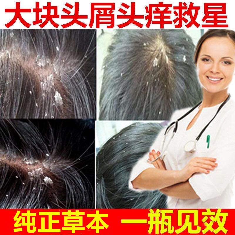 头皮癣药膏治疗头癣真菌感染银屑脂溢性皮炎毛囊炎头部专用洗发水