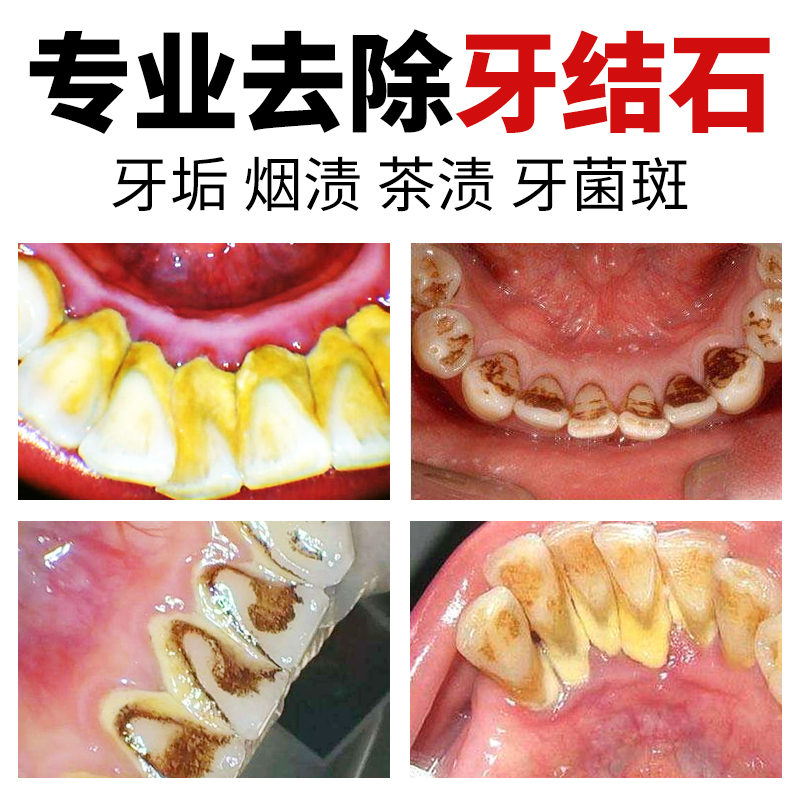 牙菌斑去掉图片