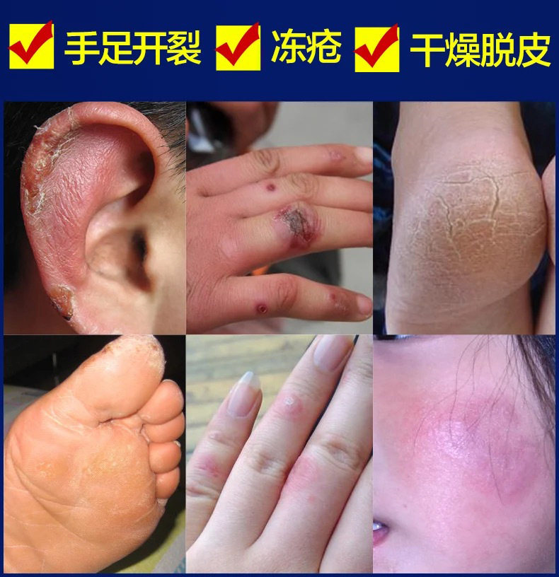 利尔康白凡士林护足护手霜润皮肤干燥手脚裂膏脚脱皮皲裂皴裂膏