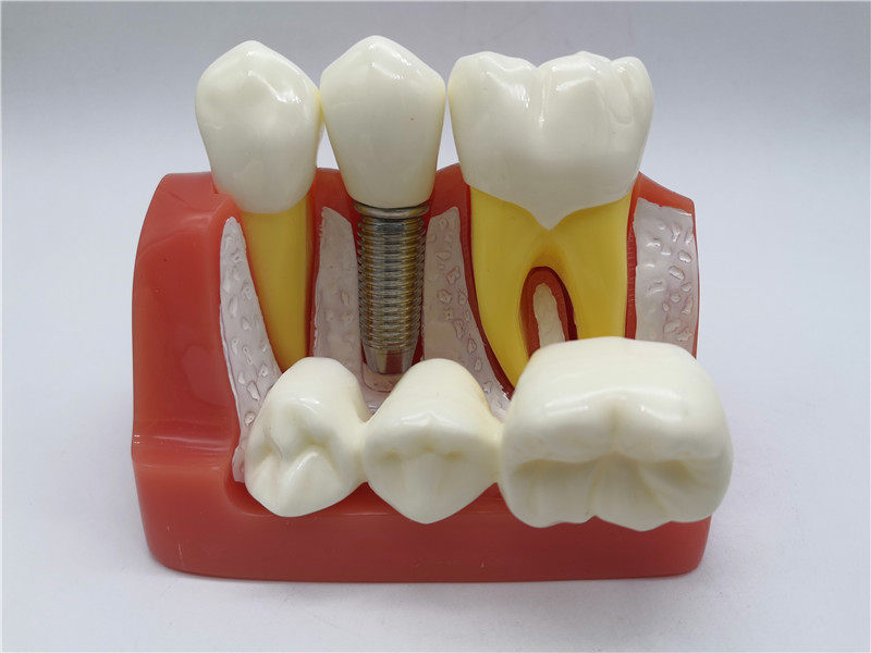 种植植体模型牙科齿科材料分解口腔教学4倍其它口腔护理设备