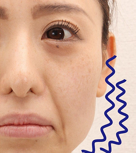 日本本原装进口紧提升鱼尾纹嘴角纹法法令八字瘦脸机