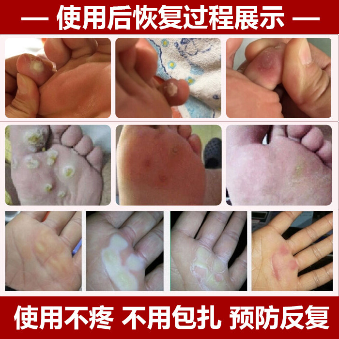 手脚鸡眼膏不疼痛鸡尤克正品趾尤肉刺血泡老厚其它