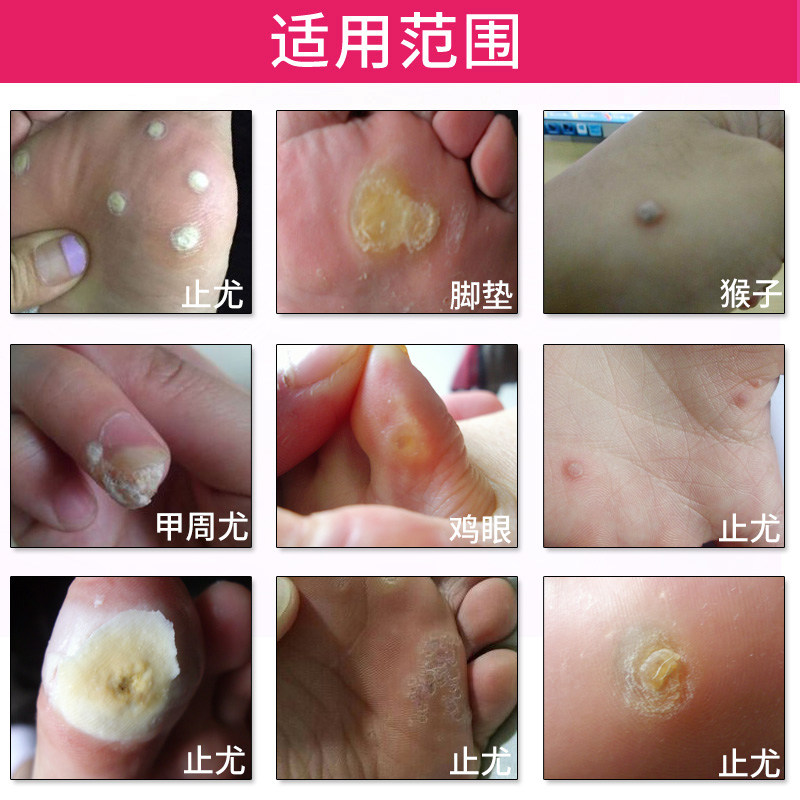 脚医生跖疣净鸡眼膏贴肉刺瘊足部去跖疣康去祛老茧疣瘊净手脚底