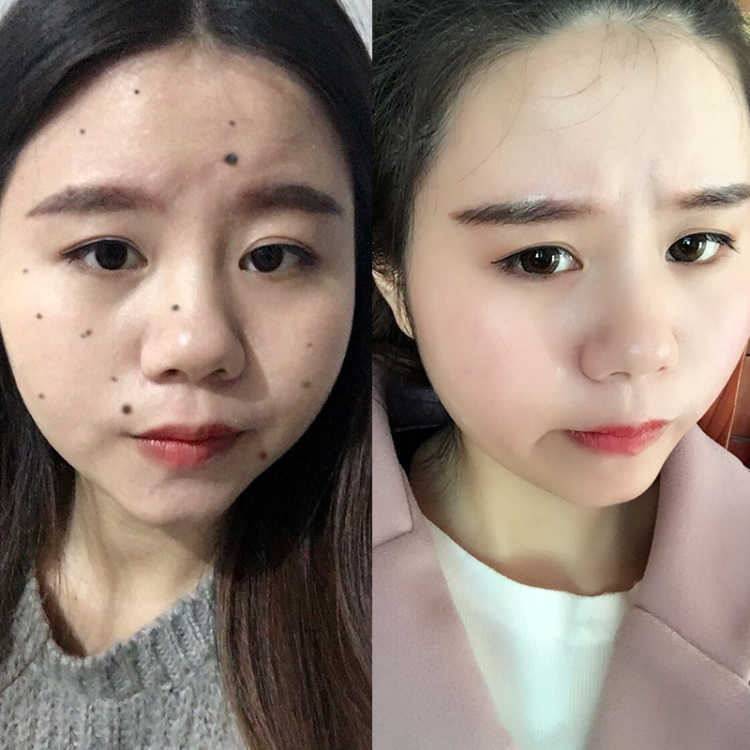 正品去痣点痣药水点痣膏无痕除痣灵去黑痣祛斑点斑水去雀斑祛痣膏