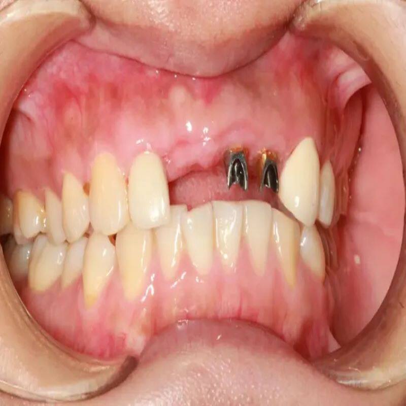 牙齿虫牙牙牙牙缝牙裂修复填堵蛀牙填充牙洞牙膏