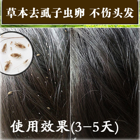 虱子药一扫光头虱儿童阴虱净男小女孩去除宠物虮子卵跳蚤粉百部酊