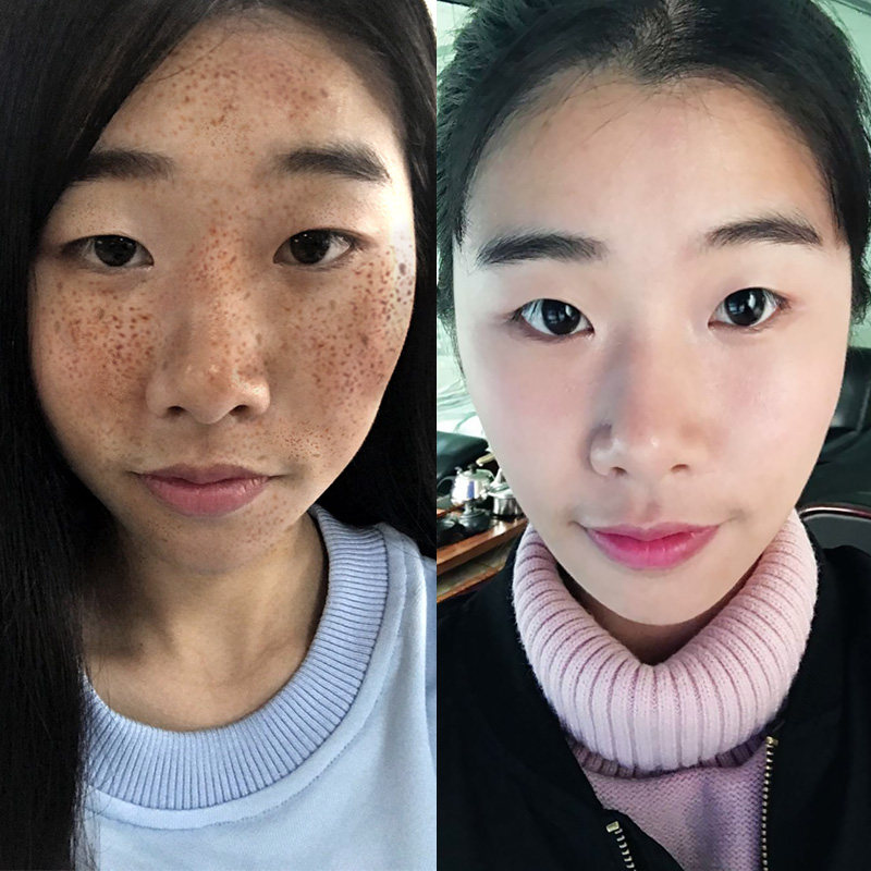【2018斑点克星】去暗黄 淡斑净白 还你笑面如花 买二送一