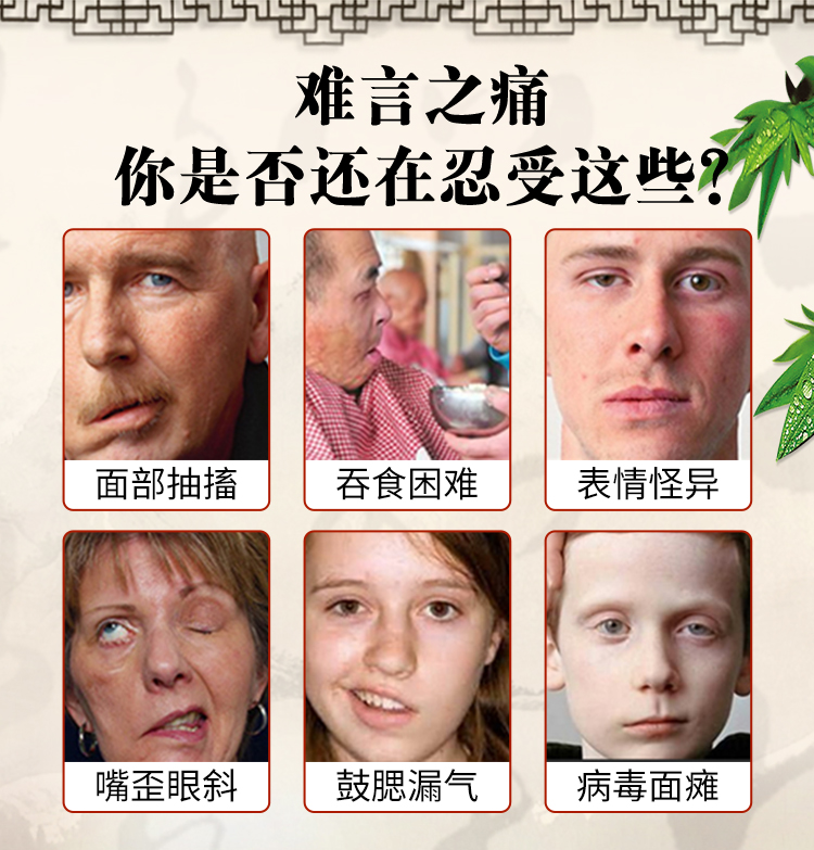 赵俊峰面瘫贴牵正膏歪嘴面瘫后遗症贴面瘫口眼联动面部痉挛面瘫