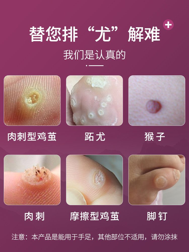 挤眼急眼鸡眼脚趾疣脚钉清茧根鸡尤净足部非去足部健康