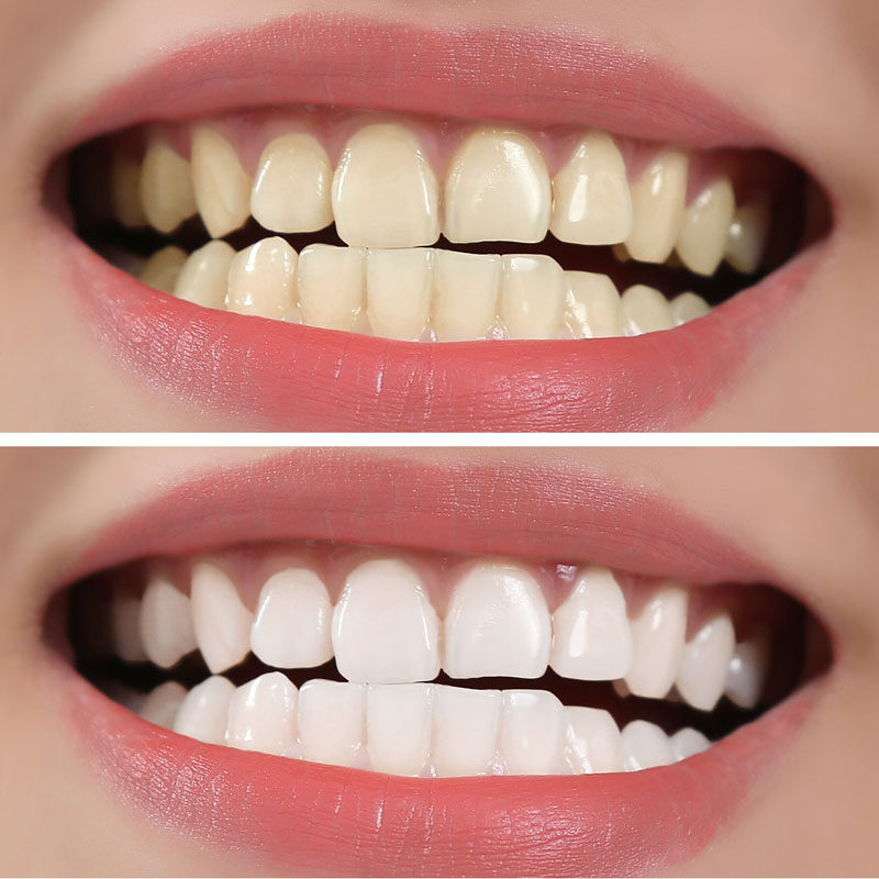 牙粉牙齿美白速效去黄牙黑牙烟牙垢快速漂白牙齿美白脱色剂