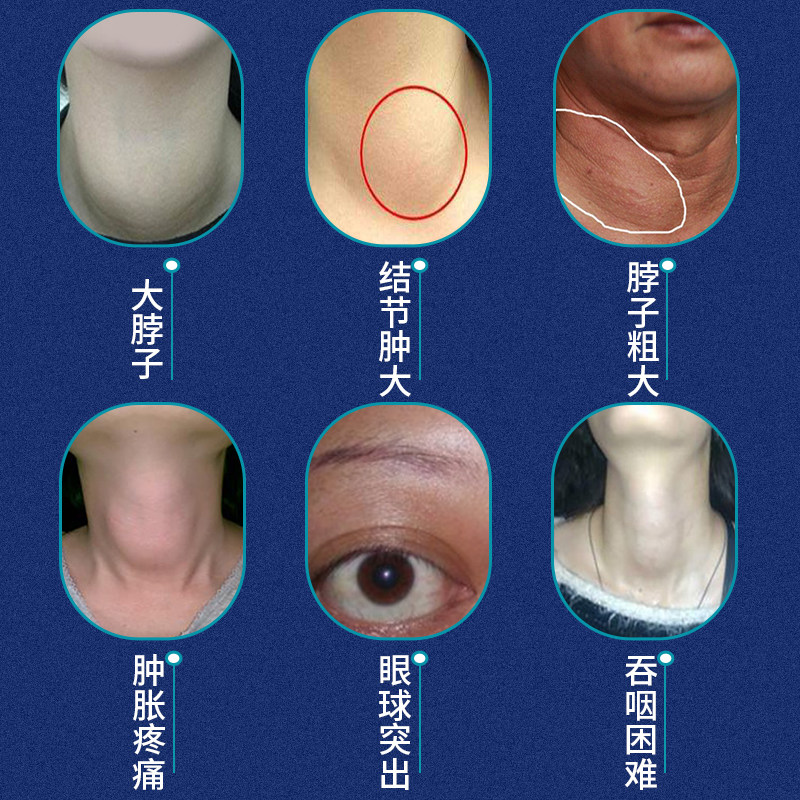 冷敷祖医甲状腺结节消贴医用结散肿大理疗膏药贴器械