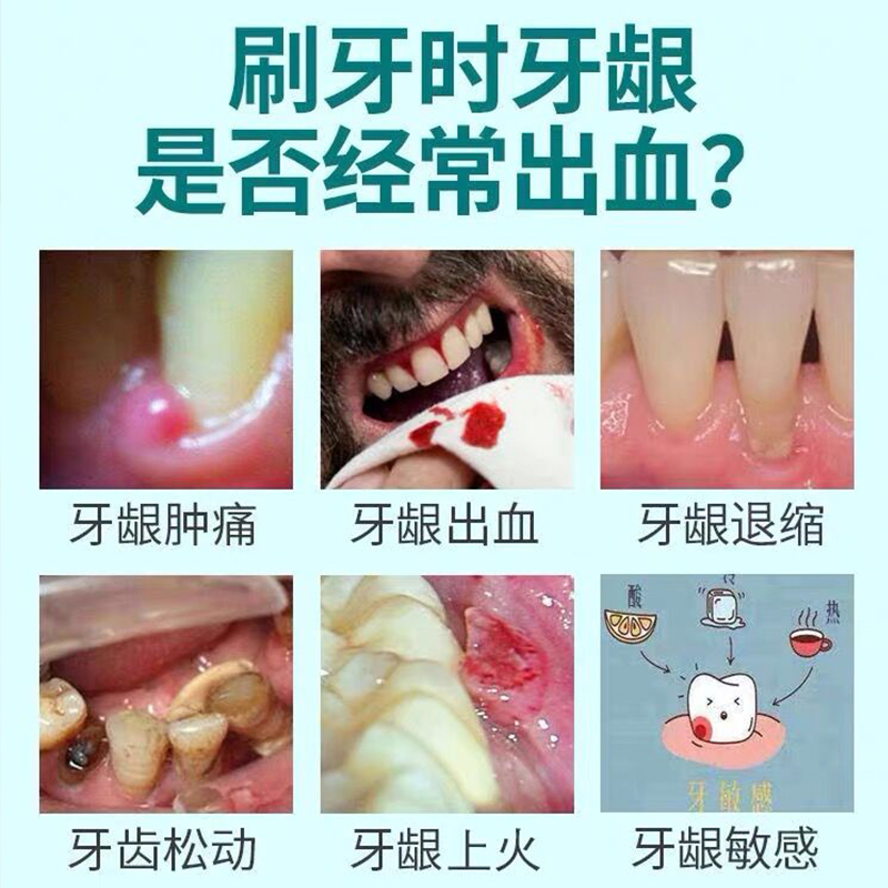牙龈出血出脓口臭牙缝宽大牙齿松动上火肿痛牙膏
