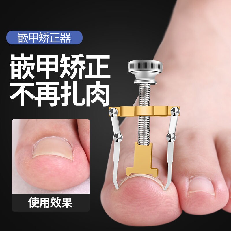 新沟反拉贴正甲贴脚趾甲嵌甲矫正专用指甲往肉里指甲钳