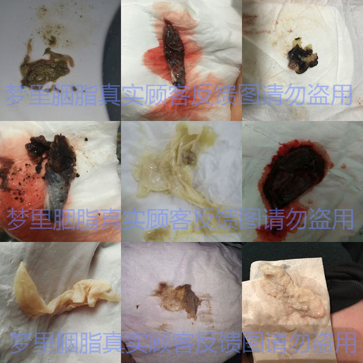 源媚妇科凝胶私处护理抑菌止痒异味子宫颈烂糜私处保养