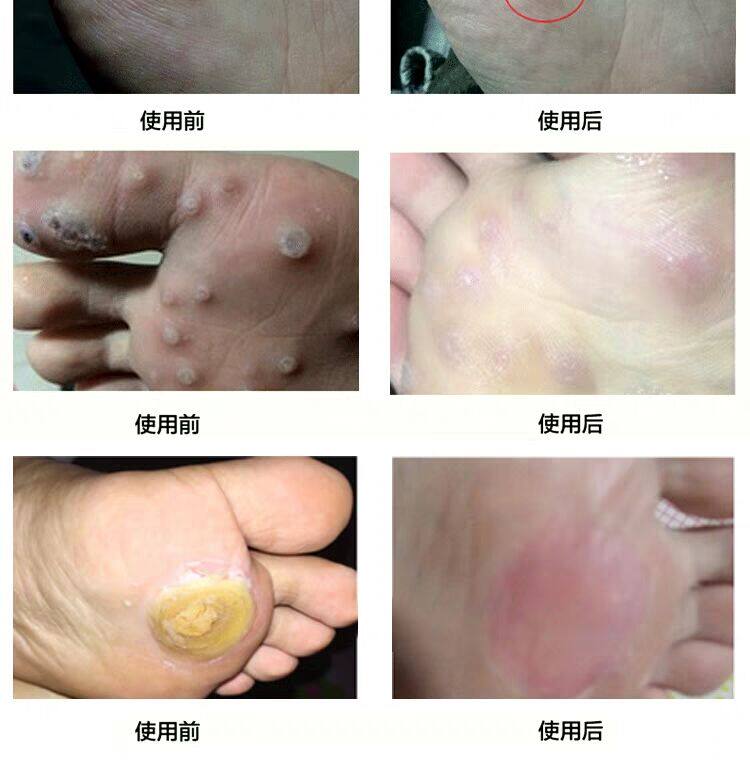 鸡眼治鸡眼的药肉刺猴子跖尤扁平尤寻常去除尤老茧的药膏正品神器