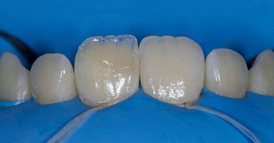 树脂特加口腔纳米补牙3m进口口腔检查