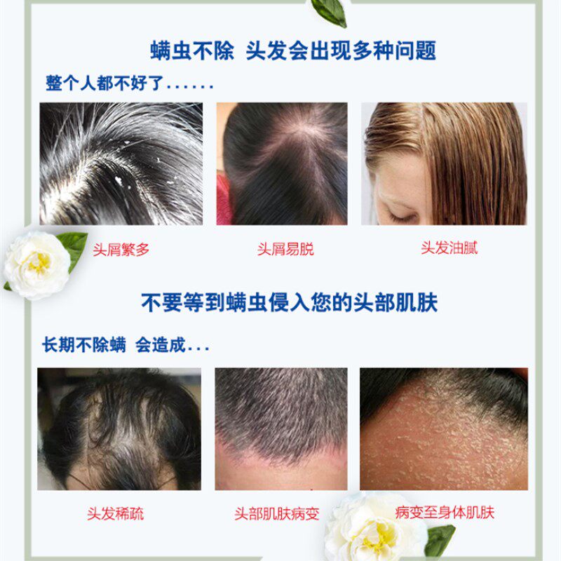 满婷洗发水去屑头剪发虫控止痒去油头皮屑杀菌洗发露洗发水