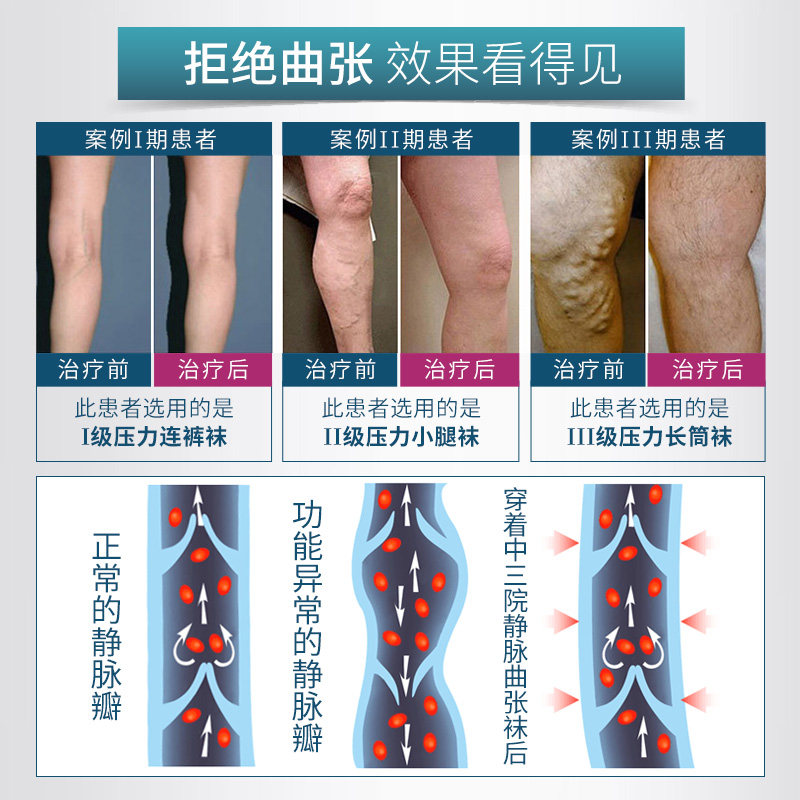 孕妇静脉曲张弹力袜治疗型四季款女男治疗型防血栓压缩袜动脉曲张