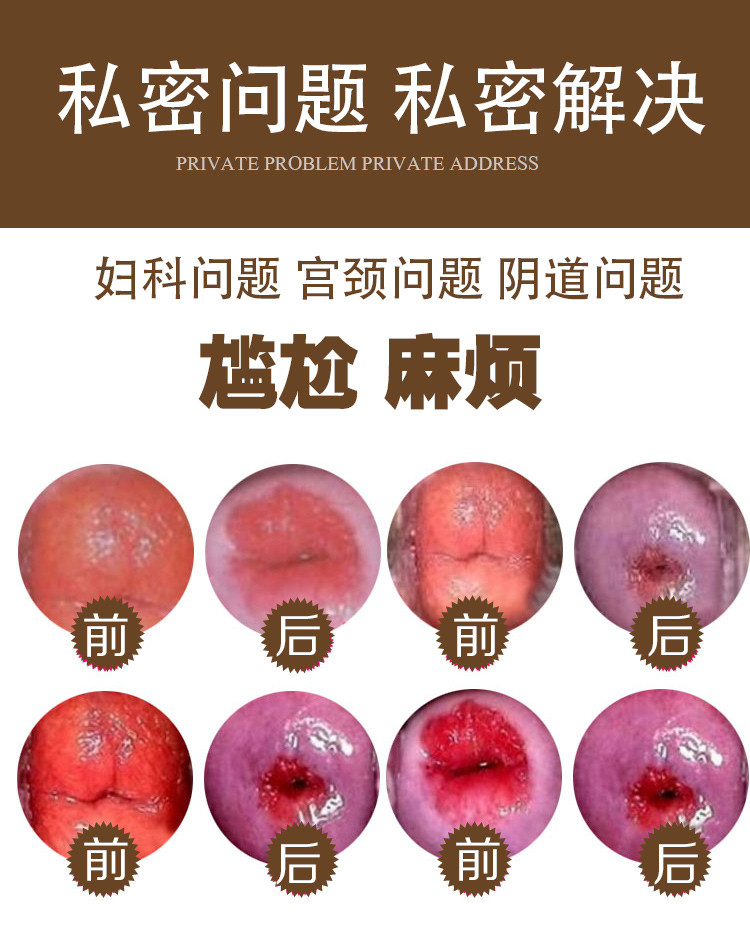 金鸡妇科凝胶私处中度宫糜霉菌阴炎杀菌止痒私处保养