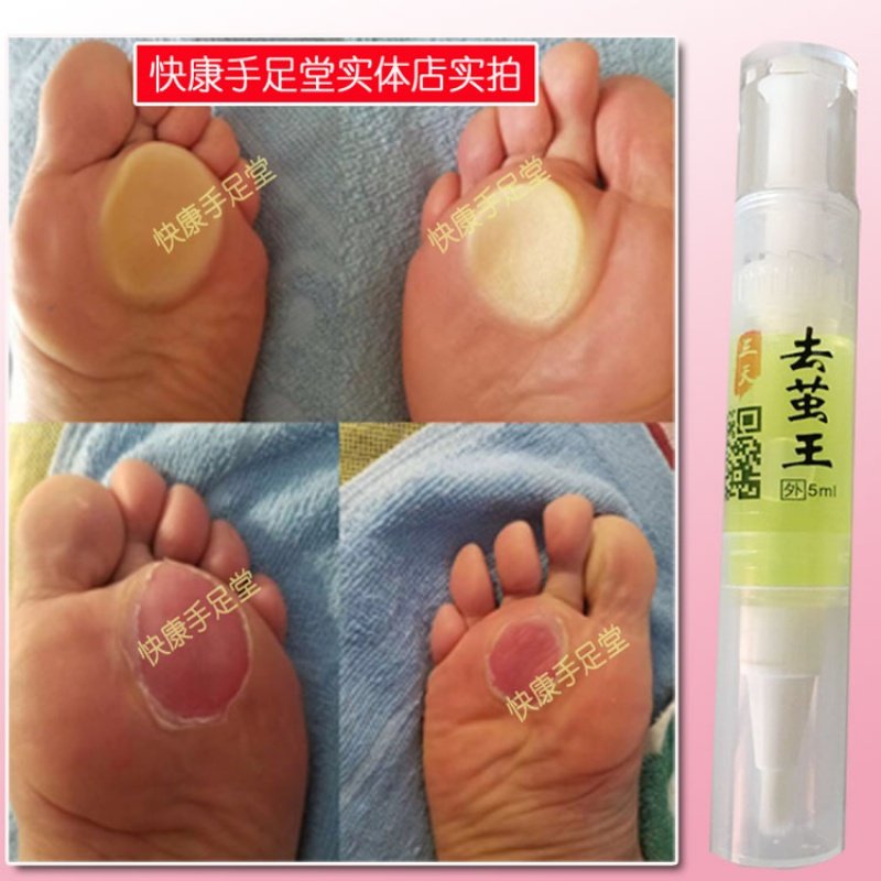 去脚老茧死皮鸡眼膏贴软化剂脚垫角质厚茧子脚茧神器脚膜去茧精油