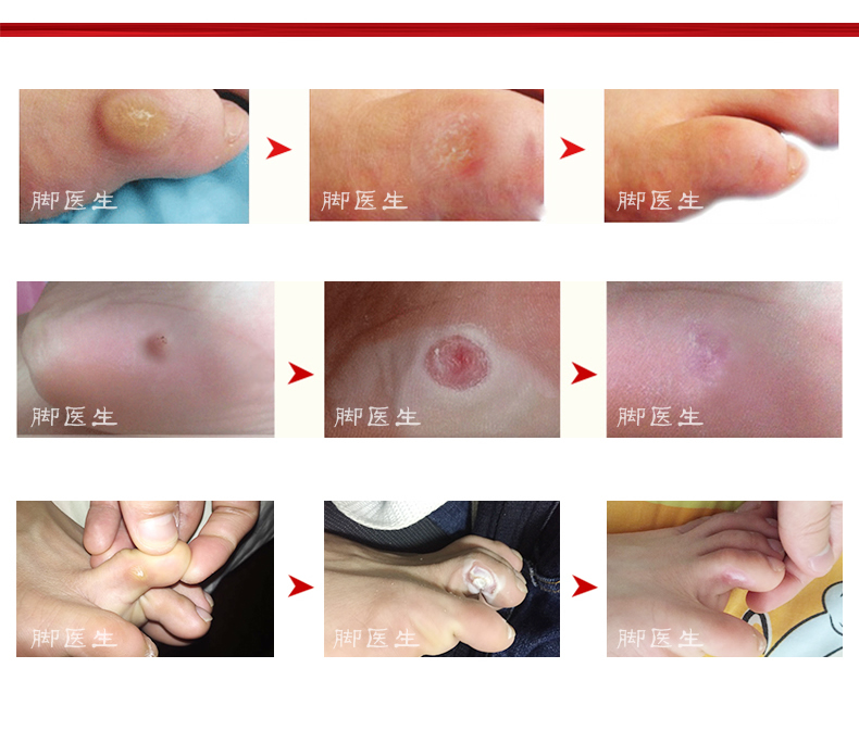 贴鸡眼膏痊愈过程图片