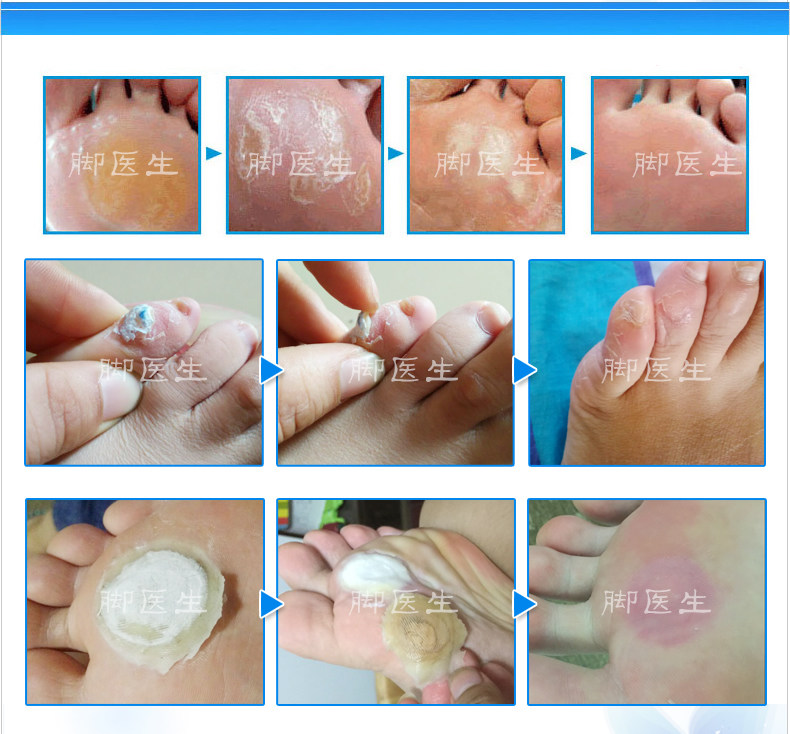 去除脚医生消茧脚底老茧膏厚茧治鸡眼膏贴脚丁药居家日用套装