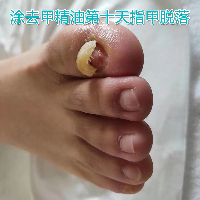 指甲知道脱甲精油去灰甲抑菌液软甲膏脱甲膏指甲彩妆