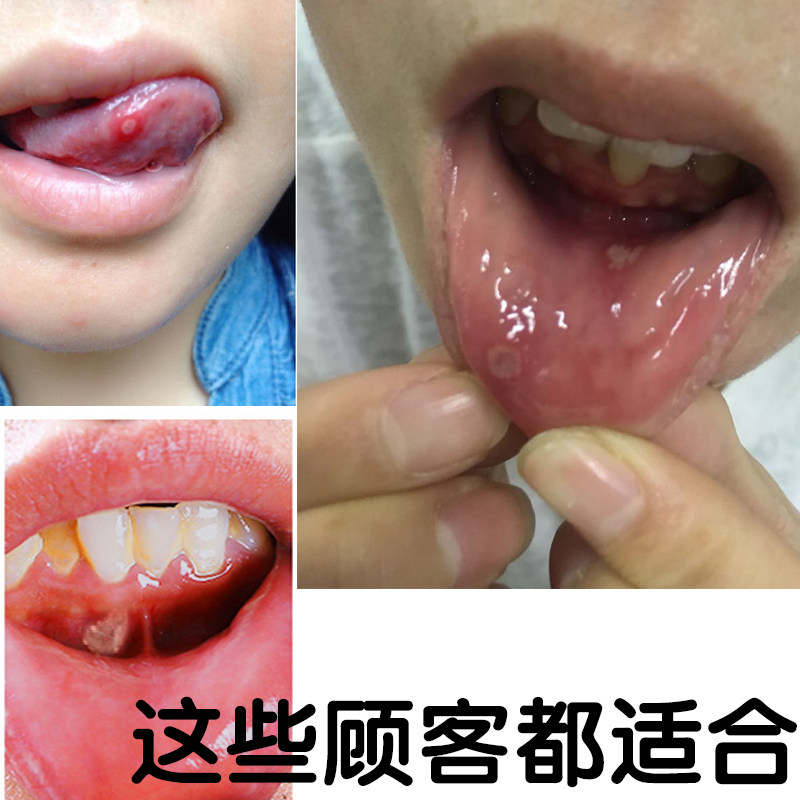 正品牙得安一点灵1.5ml口腔内壁嘴巴烂上火粘膜红肿防溃送涂药棒