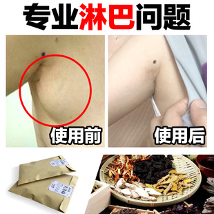 腹股沟淋巴 男性图片