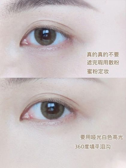 Suetnei Sangyue 흑백 흰색 무광택 형광 형광 형광 형광 형광 형광도 눈물 트로프 Nasolabial Folds Facial Facial Facial Facial 수리 트레이 Suetnei Sangyue 흑백 흰색 무광택 형광 형광 형광 형광 형광 형광도 눈물 트로프 Nasolabial Folds Facial Facial Facial Facial 수리 트레이