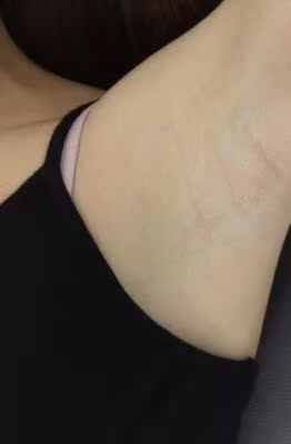 用过一段时间了，真的已经不黑了，这个地方恢复得很好，现在看来真的效果挺好的，这样到夏天穿背心的时候就不用遮遮掩掩的了，还打算再回购用在其他的部位