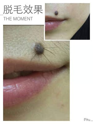 效果很满意，脱毛很干净，再也不做女汉子了，会无限回购