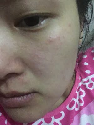 脸部开始过敏了洗完了都是痘痘，虽然是过敏体质但是用洗面奶都没事心塞