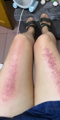 东西今天收到的，迫不及待用了，效果很好，可能是我不受力，感觉吸力好大啊，已经调到最小了吸的我还是痛，出了很多的痧气，做完了腿挺舒服，下次叫我老公给我做背，坚决支持，真的不错呢，价格也实惠，南极人的忠实拥护者，我可不是托