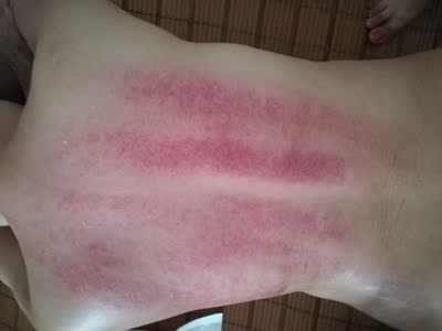 我是个很注重养生的人,一直在美容院做开背,走罐的项目。自己平时还时不时购买养生产品,自己保护自己。刮痧板、拔罐器买了很多,结果很无意的机会看到了这个神器,简直就是神助手。以后可以不用去美容院了。这是个拔罐、走罐神器。尤其是涌泉穴,以前我很难用火罐拔,有了这个拔罐助手,我再也不愁了。幸福~ 虽然购买时出了点小状况,但是客服很快的解决了~不错的售后服务。😍 我是个很注重养生的人,一直在美容院做开背,走罐的项目。自己平时还时不时购买养生产品,自己保护自己。刮痧板、拔罐器买了很多,结果很无意的机会看到了这个神器,简直就是神助手。以后可以不用去美容院了。这是个拔罐、走罐神器。尤其是涌泉穴,以前我很难用火罐拔,有了这个拔罐助手,我再也不愁了。幸福~ 虽然购买时出了点小状况,但是客服很快的解决了~不错的售后服务。😍