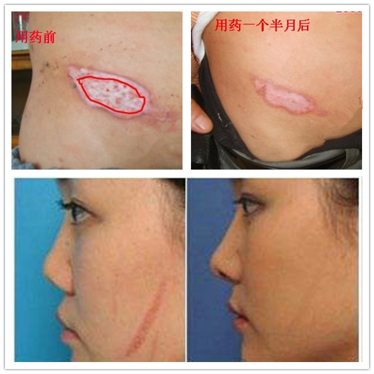 去旧烟烫增生修复祛除疙瘩性凹凸烧伤药疤痕印软化纹身黑色素沉着