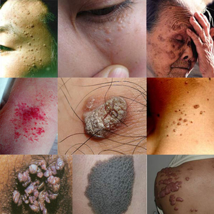 软膏 重组人干扰素 扁平尤面部痦 鬼臼毒素酊软膏 痣