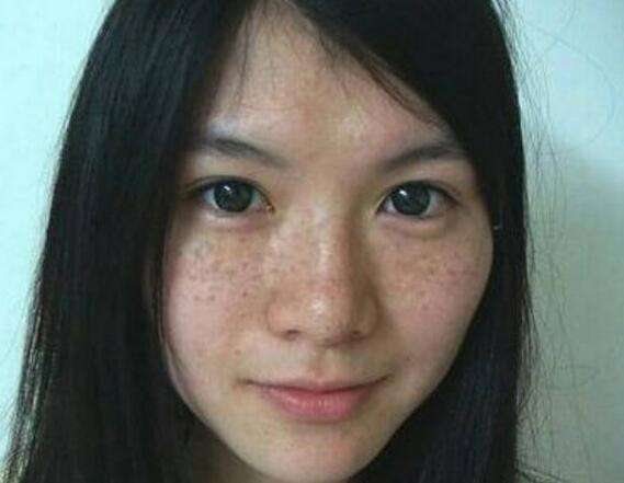 年纪轻轻就有蝴蝶斑, 八成是它在搞鬼