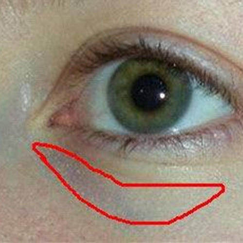 可导致贫血,也会产生黑眼圈,同时嘴唇和眼结膜也会显得很苍白